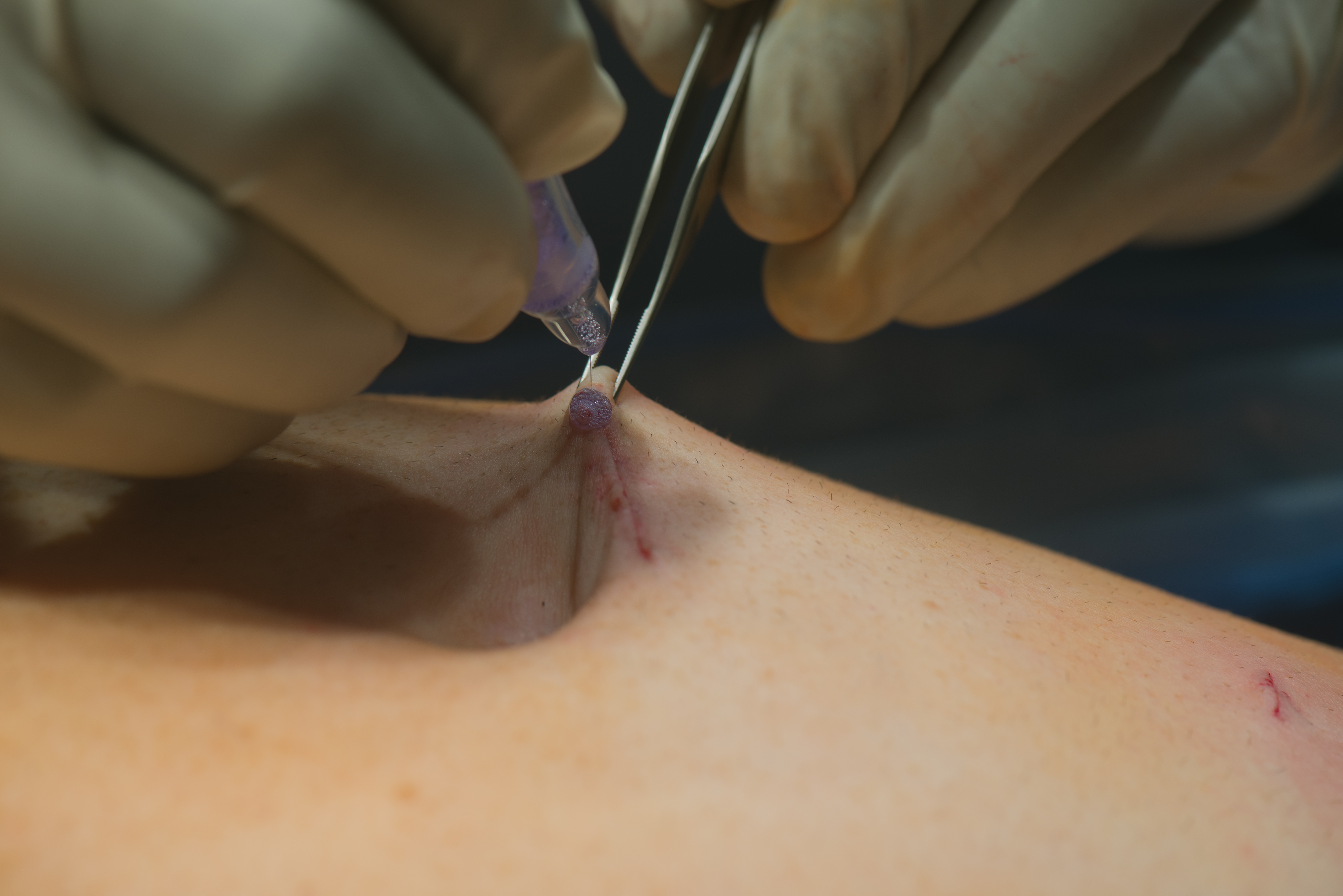 La cirugía laparoscópica de la hernia inguinal usa incisiones más pequeñas que la reparación abierta tradicional.La diferencia es más evidente cuando se realiza una reparación bilateral.